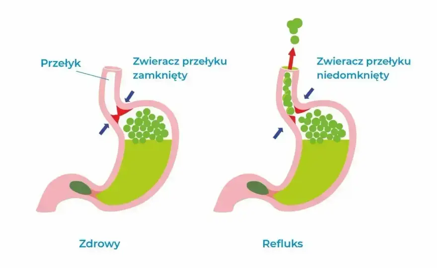 Gula w gardle – Czy to globus, refluks czy coś poważnego?